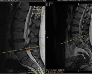 Read more about the article Tratament chiropractic hernie de disc – rezultate