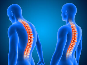 Read more about the article Cifoză Cluj-Napoca — Tratament Spate Rotund la Tineri și Adulți | Chiromedica
