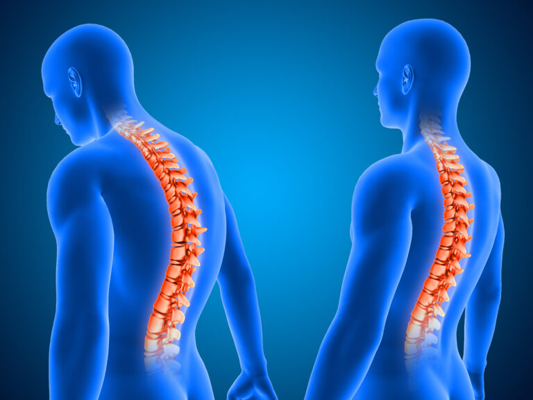 Read more about the article Cifoză Cluj-Napoca — Tratament Spate Rotund la Tineri și Adulți | Chiromedica